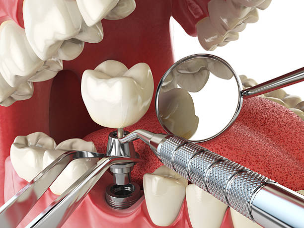 Best Emergency Dental Care for Broken or Chipped Teeth in Centre Hall, PA